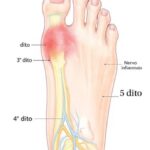 piede neuroma di morton